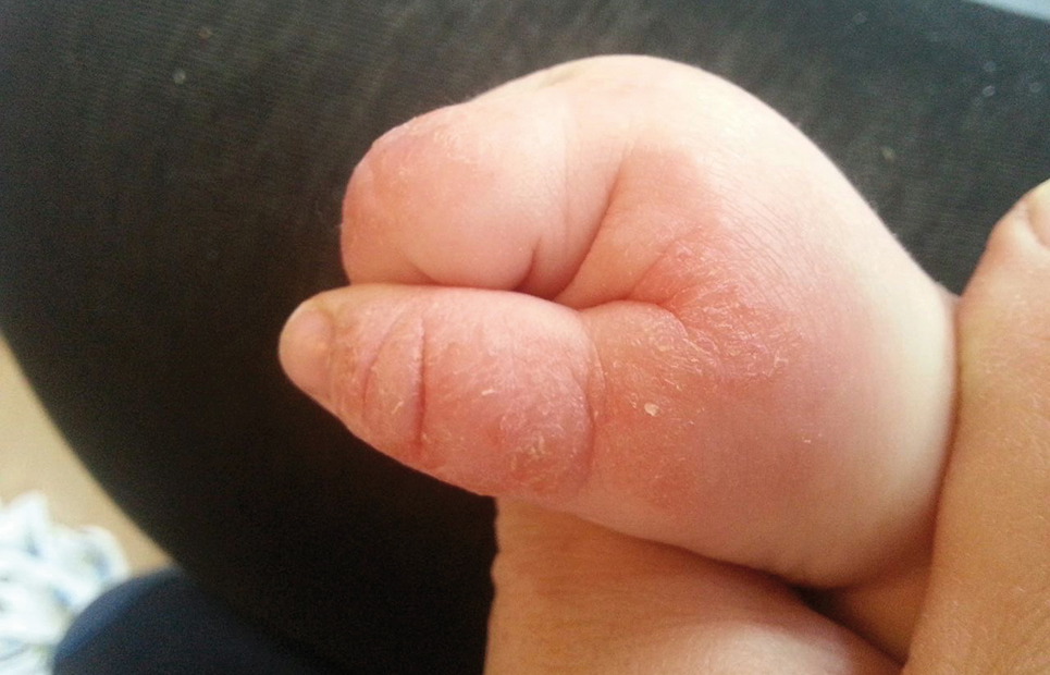 Babyhändchen mit Neurodermitis
